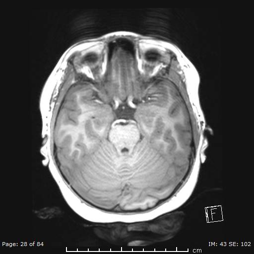 Balo concentric sclerosis (Radiopaedia 61637-69636 Axial T1 28).jpg