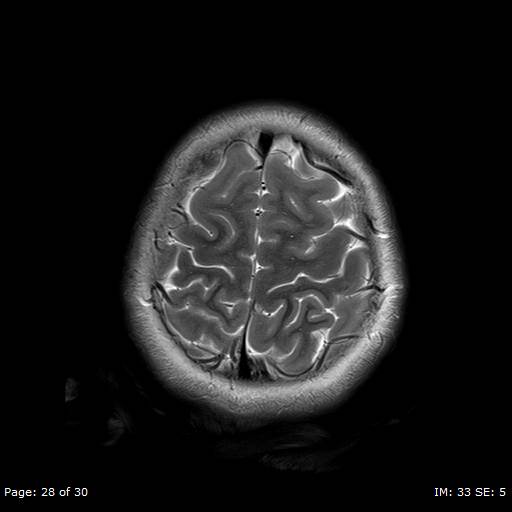 File:Balo concentric sclerosis (Radiopaedia 61637-69636 Axial T2 28).jpg