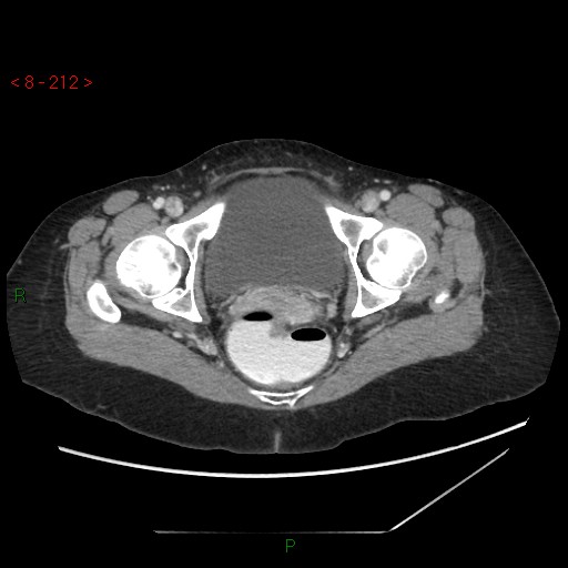 Bartholin gland cyst (Radiopaedia 54904-61181 A 53).jpg