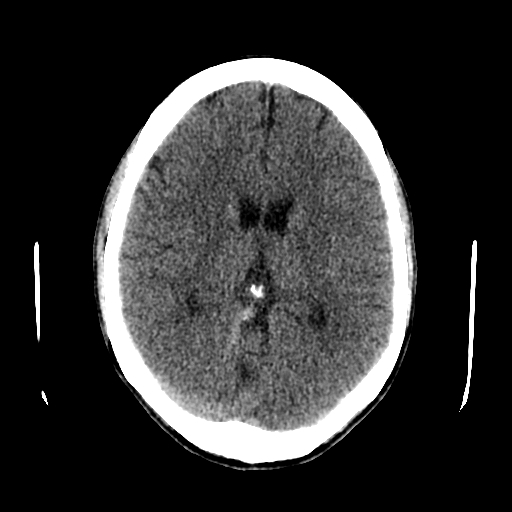File:Basilar artery perforator aneurysm (Radiopaedia 82455-96597 Axial non-contrast 20).jpg