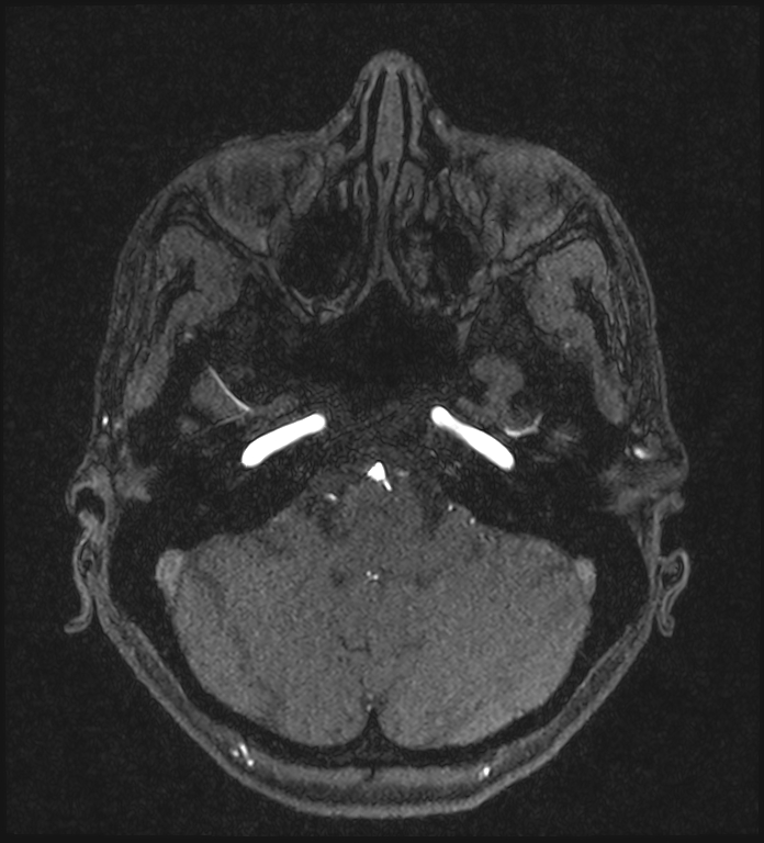 Basilar artery perforator aneurysm (Radiopaedia 82455-97733 Axial MRA 57).jpg