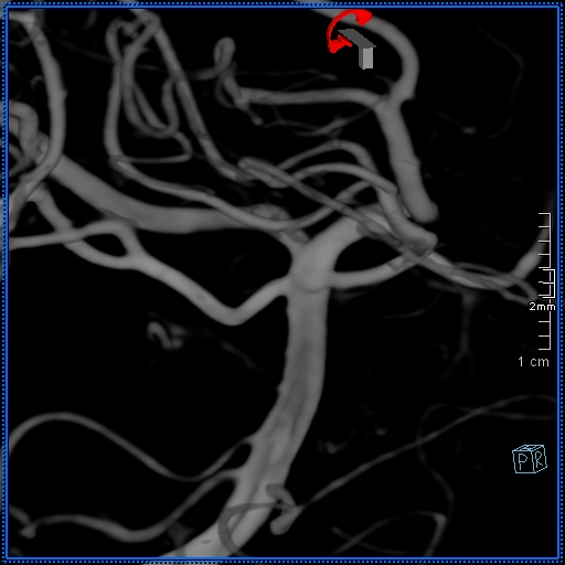 Basilar artery perforator aneurysm (Radiopaedia 82455-99524 3D Left VA 79).jpg