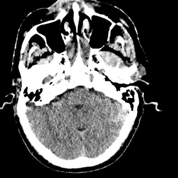 Basilar artery thrombosis (Radiopaedia 53351-59333 Axial non-contrast 40).jpg