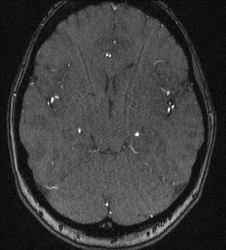 Basilar tip aneurysm (Radiopaedia 26504-26632 MRA 104).jpg