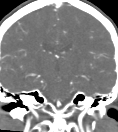 Basilar tip aneurysm with coiling (Radiopaedia 53912-60086 B 83).jpg