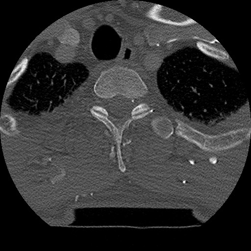 Benign post-traumatic pseudopneumoperitoneum (Radiopaedia 71199-81495 Axial bone window 39).jpg