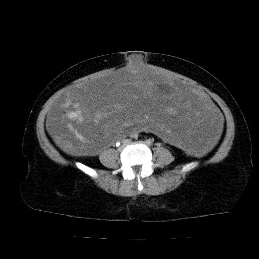 Benign spindle cell tumor - abdominopelvic (Radiopaedia 61300-69212 Axial C+ delayed 40).jpg