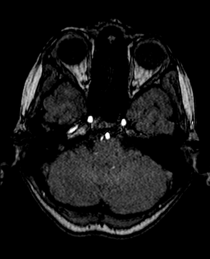 Berry aneurysm of the terminal internal carotid artery (Radiopaedia 88286-104918 Axial TOF 71).jpg
