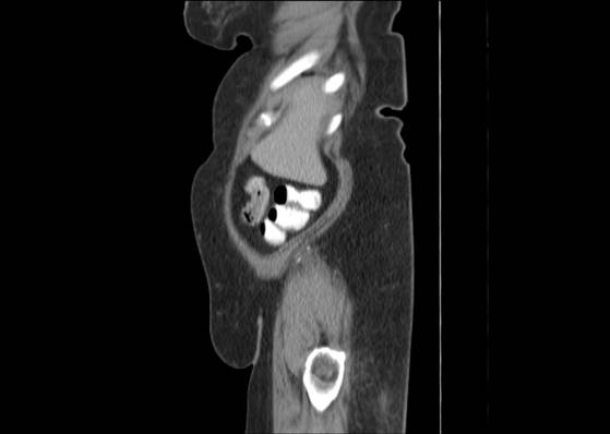Bicameral celiacomesenteric aneurysm (Radiopaedia 55766-62327 B 7).jpg