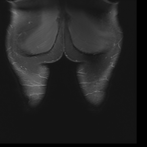 File:Biceps femoris strain injury (Radiopaedia 16800-16515 Coronal STIR 1).jpg
