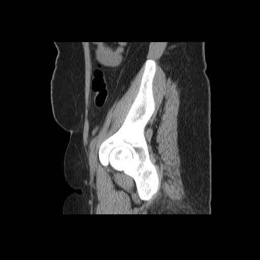 File:Bicornuate uterus- on MRI (Radiopaedia 49206-54296 A 19).jpg