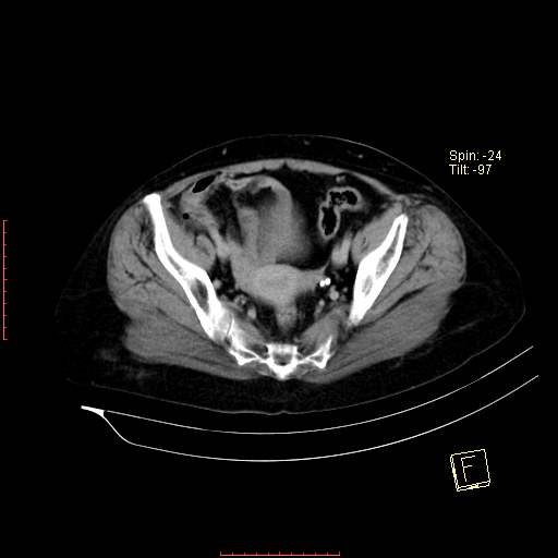 File:Bifid ureter (Radiopaedia 47604-52253 Axial C+ delayed 24).jpg
