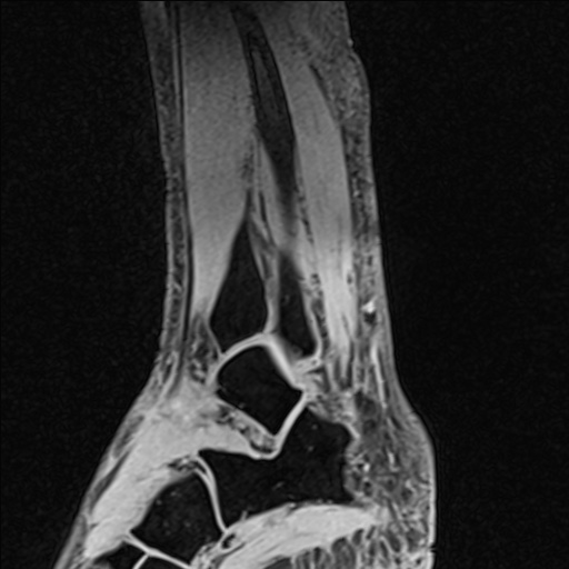 File:Bilateral Achilles tendon complete tear (Radiopaedia 81344-95051 Sagittal WE - Left 82).jpg