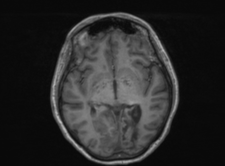 Bilateral PCA territory infarction - different ages (Radiopaedia 46200-51784 Axial T1 248).jpg