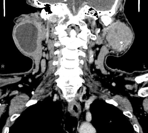 File:Bilateral Warthin tumors (Radiopaedia 84034-99263 C 31).jpg