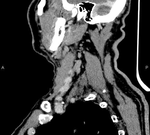 Bilateral Warthin tumors (Radiopaedia 84034-99263 D 26).jpg