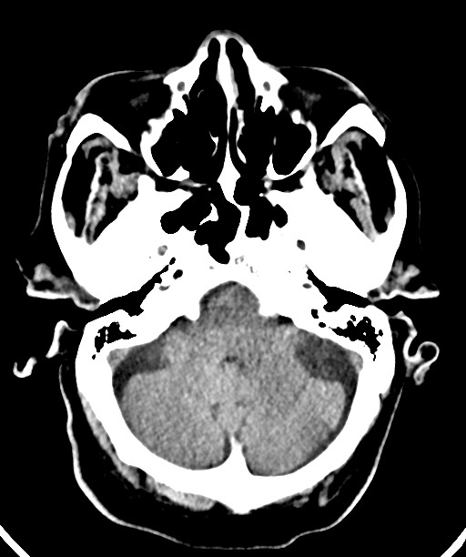 Bilateral acute on chronic subdural hematomas (Radiopaedia 78466-91146 Axial non-contrast 16).jpg