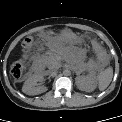 Bilateral adrenal gland hyperenhancement in pancreatitis (Radiopaedia 86642-102753 Axial non-contrast 45).jpg