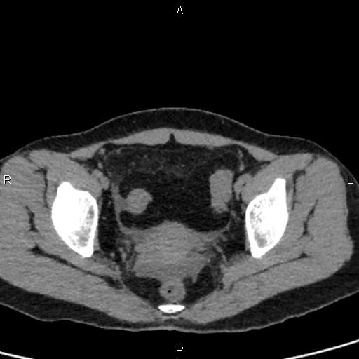 Bilateral adrenal gland hyperenhancement in pancreatitis (Radiopaedia 86642-102753 Axial non-contrast 99).jpg