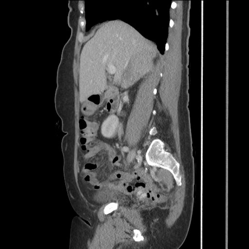 Bilateral adrenal granulocytic sarcomas (chloromas) (Radiopaedia 78375-91007 C 58).jpg