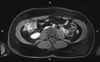 File:Bilateral adrenal myelolipoma (Radiopaedia 63058-71537 H 65).jpg