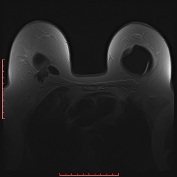 File:Bilateral breast implant rupture (Radiopaedia 24761-25027 PASTA 8).jpg