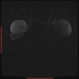 File:Bilateral breast implant rupture (Radiopaedia 24761-25027 PASTA Si IR 12).jpg