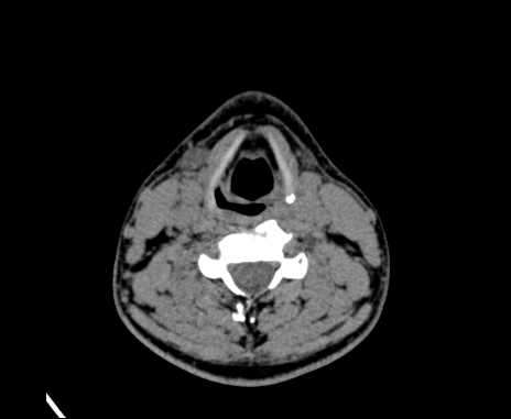 Bilateral carotid body tumors (Radiopaedia 61841-69870 Axial non-contrast 64).jpg