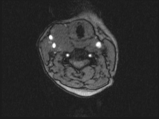 Bilateral carotid body tumors and right glomus jugulare tumor (Radiopaedia 20024-20060 Axial MRA 244).jpg