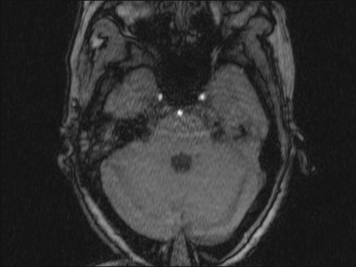 Bilateral carotid body tumors and right glomus jugulare tumor (Radiopaedia 20024-20060 Axial MRA 323).jpg