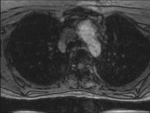 File:Bilateral carotid body tumors and right jugular paraganglioma (Radiopaedia 20024-20060 Axial 261).jpg