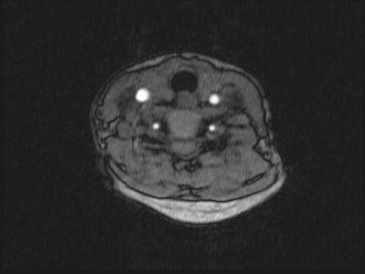 File:Bilateral carotid body tumors and right jugular paraganglioma (Radiopaedia 20024-20060 Axial 335).jpg