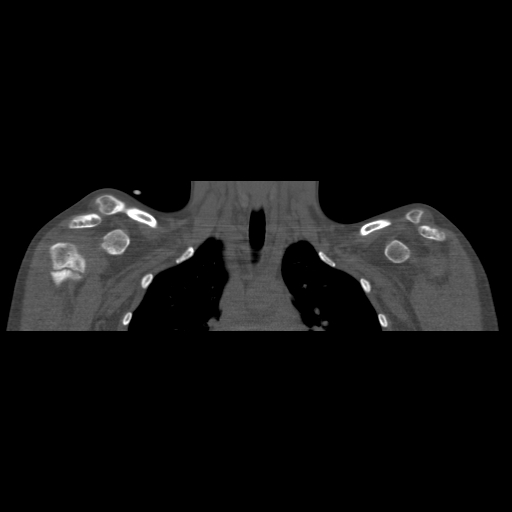 Bilateral chronic posterior shoulder dislocation (Radiopaedia 39213-41452 Coronal bone window 20).jpg