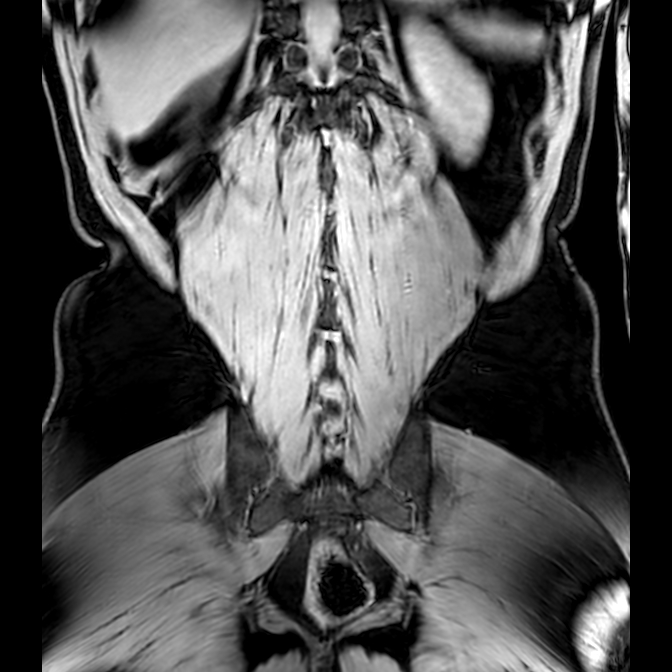Bilateral conjoined nerve roots at different levels (Radiopaedia 73312-84063 Coronal WE 48).jpg