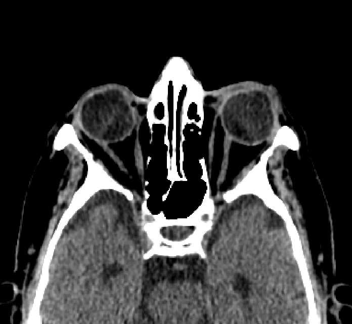 Bilateral ectopia lentis (Radiopaedia 89889-107013 Axial non-contrast 43).jpg