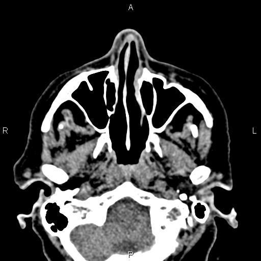 Bilateral enlargement of lacrimal glands - sarcoidosis (Radiopaedia 62627-70921 Axial non-contrast 11).jpg