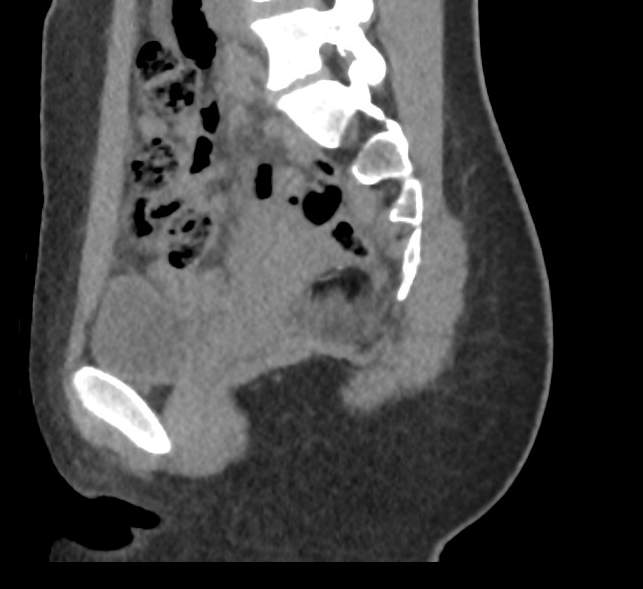 File:Bilateral mature cystic ovarian teratoma (Radiopaedia 88821-105592 D 23).jpg