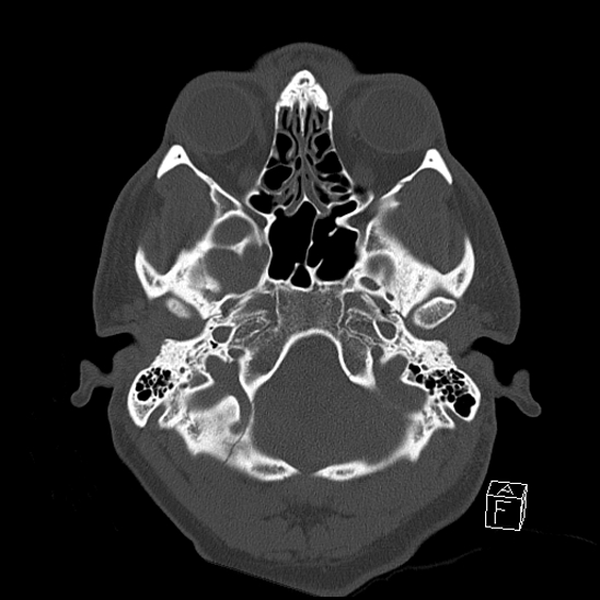 File:Bilateral occipital condyle fracture (type 2) (Radiopaedia 87675-104089 Axial bone window 21).jpg