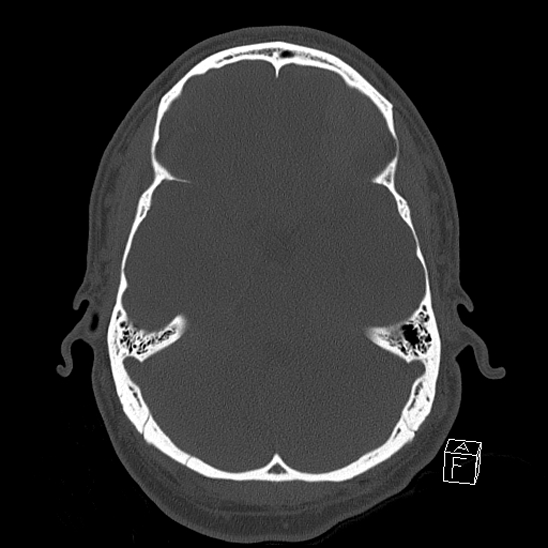 Bilateral occipital condyle fracture (type 2) (Radiopaedia 87675-104089 Axial bone window 44).jpg