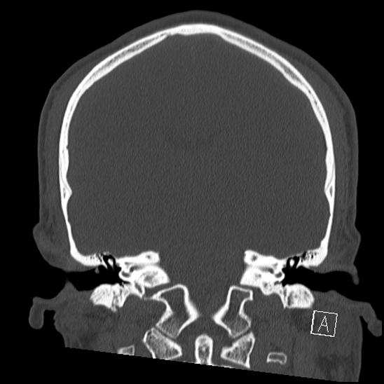 Bilateral occipital condyle fracture (type 2) (Radiopaedia 87675-104089 Coronal bone window 76).jpg