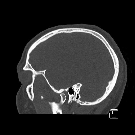 Bilateral occipital condyle fracture (type 2) (Radiopaedia 87675-104089 Sagittal bone window 14).jpg
