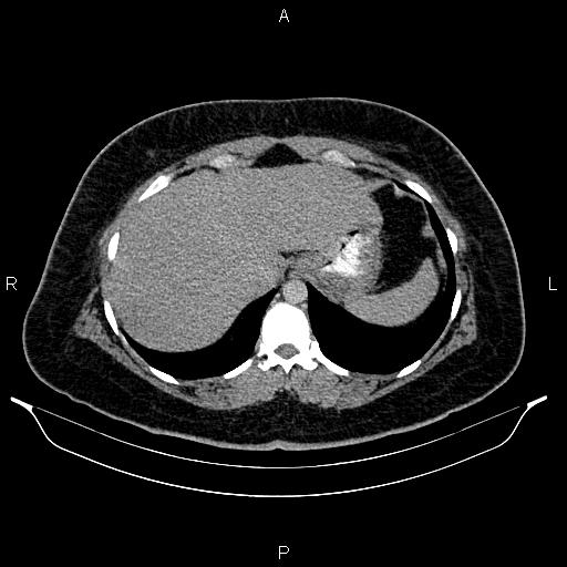 Bilateral ovarian dermoid cysts (Radiopaedia 85785-101603 Axial C+ delayed 5).jpg