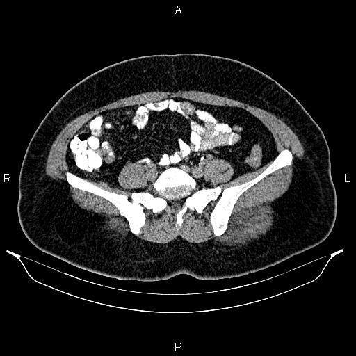 Bilateral ovarian dermoid cysts (Radiopaedia 85785-101603 Axial C+ delayed 55).jpg