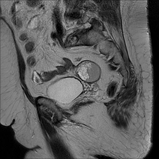 File:Bilateral ovarian dermoid cysts (Radiopaedia 90152-107338 Sagittal T2 9).jpg