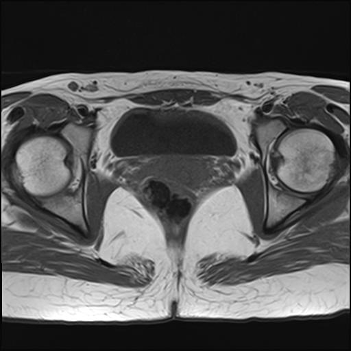 File:Bilateral ovarian endometriomas (Radiopaedia 87085-103347 Axial T1 16).jpg