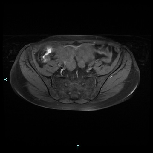 File:Bilateral ovarian fibroma (Radiopaedia 44568-48293 Axial T1 fat sat 7).jpg