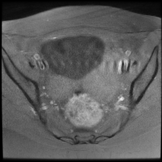 File:Bilateral ovarian fibrothecomas - adolescent (Radiopaedia 86604-102707 Axial T1 fat sat 15).jpg