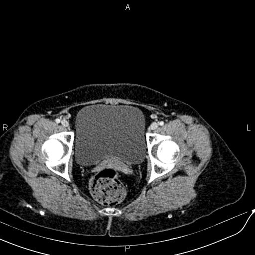 Bilateral ovarian serous cystadenocarcinoma (Radiopaedia 86062-101989 B 95).jpg
