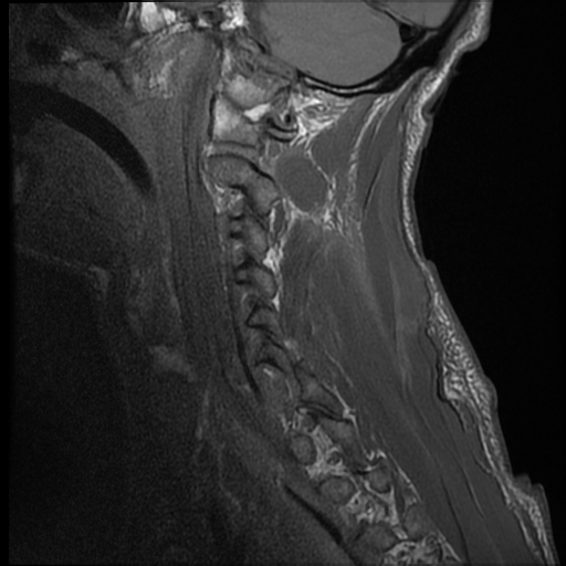 File:Bilateral perched facets with cord injury (Radiopaedia 45587-49714 Sagittal T1 14).jpg
