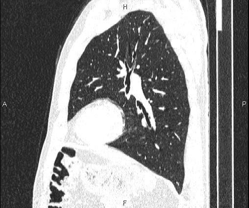 Bilateral pulmonary AVM (Radiopaedia 83134-97505 Sagittal lung window 78).jpg